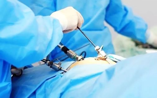 Kapalı Çikolata Kisti Ameliyatı